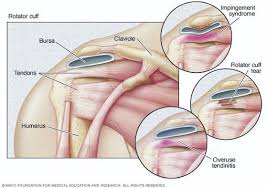 Once the ligaments, tendons, and muscles around the shoulder become loose or torn, dislocations can occur repeatedly. My Shoulder Hurts