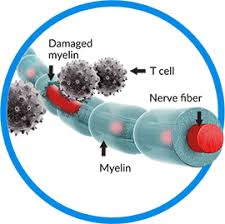 Relapsing Remitting Multiple Sclerosis Betaseron Interferon Beta 1b