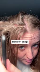 Red and Itchy Scalp Relief: Dandruff Dump