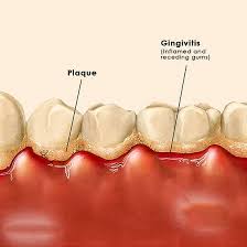 Image result for Gingivitis