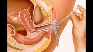 Maybe you would like to learn more about one of these? Ø§ÙƒØªØ¨ ØªÙ‚Ø±ÙŠØ± Ù…Ù‚ÙŠØ¯ Ø§Ù„Ø¥ØµØ¯Ø§Ø± Ø·Ø±ÙŠÙ‚Ø© Ø§Ù„ØªÙ„Ù‚ÙŠØ­ Ø§Ù„ØµÙ†Ø§Ø¹ÙŠ Ø§Ù„Ù…Ù†Ø²Ù„ÙŠ Cedarmantel Com