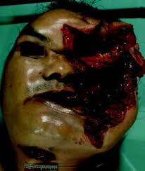 A.50 calibre bullet would have took my arm off so i guess i'm lucky i was just stabbed. Gunshot Wound Deaths Springerlink