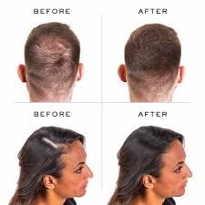 Ships from and sold by onenine beauty. 10 Best Hair Loss Concealer Reviews In 2020 Hold The Hairline