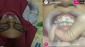 Jika dipasang di klinik kerajaan, berapakah. Doktor Fake Braces Semakin Mengganas Kali Ini Siap Buat Live Di Instagram Kongsi Tular Semasa Forum Cari Infonet
