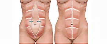 Cauze frecvente ale durerii lombare in partea stanga. Diastaza Abdominala Apollus Institute Clinica Bucuresti