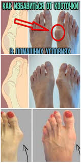 как избавиться от косточки на ноге в домашних условиях Kostochka Na Stope 5 Rabotayushih Sposobov Dlya Izbavleniya Varikoz Zdorove Naturalnaya Medicina