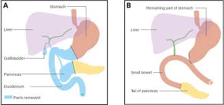 Pancreatic Cancer Clinical Features Management Teachmesurgery