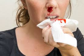 Image result for Epistaxis