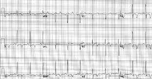Image result for Exercise Induced Syncope