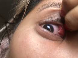Eyelid flip learning this neat trick may be awkward and a bit painful at first but practice makes professional and the chronicles of trippytrap 1second eyelid flip by a 3 year old girl. Bump On The Inner Upper Eyelid Web Eye Clinic