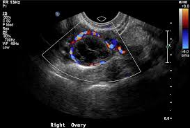 Image result for corpus luteum sonography)