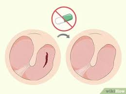 If possible, don't fly if you have a cold or an active allergy that causes nasal or ear congestion. How To Heal A Ruptured Eardrum 15 Steps With Pictures Wikihow
