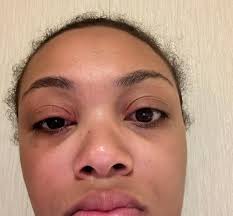 Please what cream or soap can I use to treat eyzema