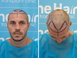 Bury's Scott Quigg speaks about stigma of losing hair after transplant