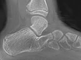 Flat valgus foot pes planovalgus med. Die Unterschiedlichen Formen Des Plattfusses Fusschirurg Dr Med Christian Kinast Munchen