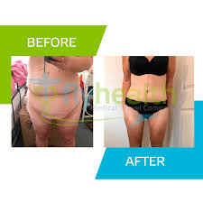 Search for pictures tummy tuck at sprask. Enhance Your Beauty I 360 Body Lift Fleur De Lis Flyhealth