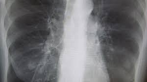 It is important to know what to expect and differences between. Copd X Ray Pictures Diagnosis And More