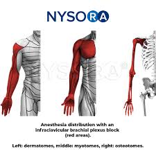 Image result for Axillary Nerve Block