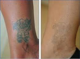 Pin On Tattoo Removal