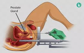 There is a chance of recovering erections, but recovery may be slow. Prostate Cancer Surgery Procedure Purpose Results Cost Price