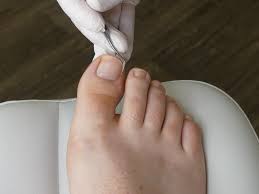 Image result for Toenail Removal