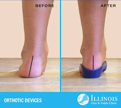 Image result for Orthotic