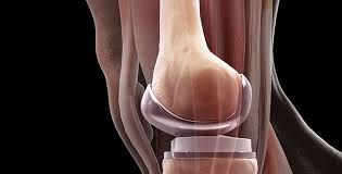 Maybe you would like to learn more about one of these? 9 Things No One Ever Tells You About Getting A Knee Replacement