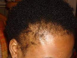 Central centrifugal cicatricial alopecia (ccca) traction alopecia. Black Woman Alopecia All You Need To Know About The Hair Disease