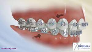 The idea behind the rubber bands here is to move the entire set of teeth in each jaw to a better position to correct your bite. Class Ii Triangle Elastics Youtube