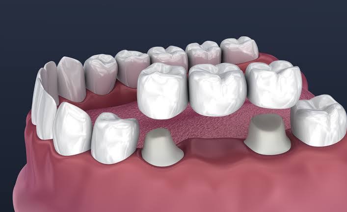 Crown and Bridge(Metal ceramic) product image