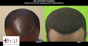 Method can help to achieve your hair restoration goals. Video Fue Punch For African American Hair Transplant Dr Upunch Curl