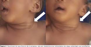 The cause of torticollis is unknown, but treatment can help. Figure 1 From Le Fibromatosis Colli Ou Torticolis Congenital Son Diagnostic Et Sa Prise En Charge A Propos De Deux Cas Semantic Scholar