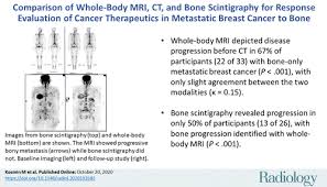 Cancer may spread, causing metastatic (stage 4) breast cancer. Comparison Of Whole Body Mri Ct And Bone Scintigraphy For Response Evaluation Of Cancer Therapeutics In Metastatic Breast Cancer To Bone Radiology