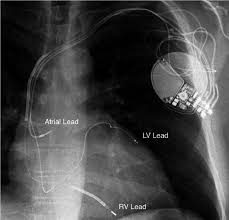 Image result for Cardiac Resynchronization Therapy