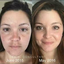 Dr. Massick, dermatologist at #OSUWexMed talks about the "melasma  mustache," and how to treat this skin discoloration.