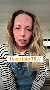 Overcoming Hair Loss: A Journey Through TSW