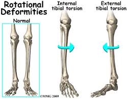Image result for Femoral Retroversion