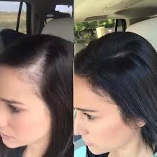 In women, it is also used to treat excessive hair growth. Hair Loss And Baldness How To Grow Receding Hairline Quora