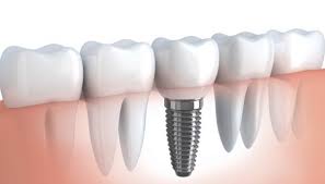 Jika anda peserta asuransi bpjs, anda tidak perlu membayar. Pasang Gigi Palsu Pakai Bpjs