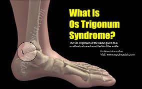 Os Trigonum Syndrome Causes Symptoms Treatment