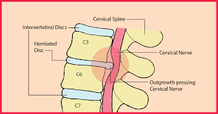 Mentioned are some of the best exercises for herniated disc: 3 Yoga Poses To Relieve Herniated Disc Pain