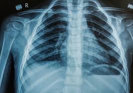 Image result for Chest XRay Interpretation