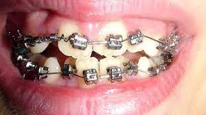 Aparelho Dentario E So Pra Quem Tem Dentes Tortos Dra Brena Felizatti