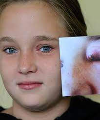 Insect Bite Leads To Hospital Stuff Co Nz
