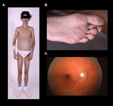 A patient with congenital lipodystrophy or lipoatrophic diabetes. Lipodystrophy Syndromes Presentation And Treatment Endotext Ncbi Bookshelf