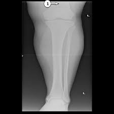 Learn vocabulary, terms and more with flashcards, games and other study tools. Tibia Fibula X Ray Labeling Questions Radiology Case Radiopaedia Org