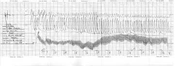 Polygraph lie detector test from $395. Green River Killer Gary Leon Ridgway S Polygraph Charts Antipolygraph Org News