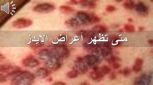 C متى تظهر أعراض الإيدز Youtube