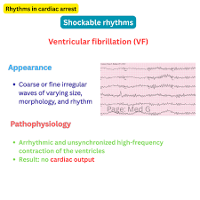 Image result for Ventricular Fibrillation Management in the Adult