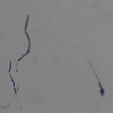 Expanded Study Confirms That Lyme Disease May Be Sexually Transmitted
